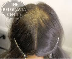 Others require prescriptions or special procedures and can be scandalously. Hair Loss In Women A Guide
