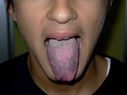 black tongue due to adrenocortical
