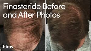 finasteride before and after photos hims