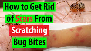 how to get rid of bed bug bites scars