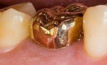 May 19, 2017 · are lil wayne's teeth dental implants or a grill? Gold Teeth Wikipedia
