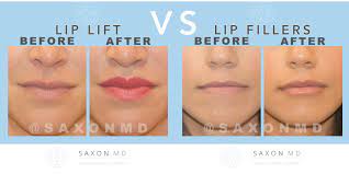 lip lifts vs lip fillers saxon md