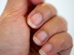 fix weak and brittle nails