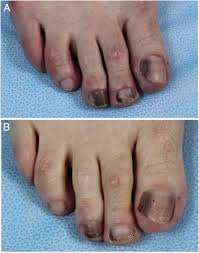 multiple nails induced by hydroxyurea