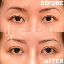 surgical asian blepharoplasty