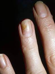 We did not find results for: What Are The White Spots On Your Nails Trying To Tell You Everyday Health