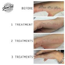 Are you worried about how to remove a permanent tattoo. Black Diamond Tattoo Lasertat Adelaide Tattoo Removal Fading