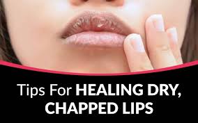 tips for healing dry chapped lips