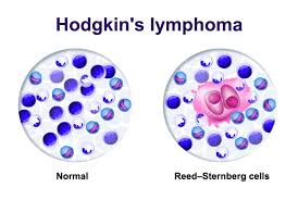 Lymphoma about half of the blood cancers that occur each year are lymphomas, or cancers of the lymphatic system. Lymphoma Blood Cancer Symptoms Treatment Mount Elizabeth Hospitals