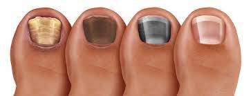 toenail discoloration making you