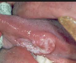 Nel mondo i tumori della faringe e della laringe rappresentano il 10 per cento circa di tutte le neoplasie maligne negli uomini e il 4 per cento nelle donne. Linee Guida Carcinoma Della Lingua E Del Pavimento Orale Andrea Rinciari