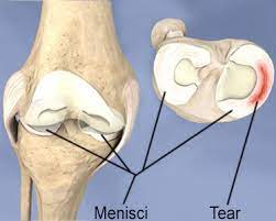 torn meniscus symptoms healing