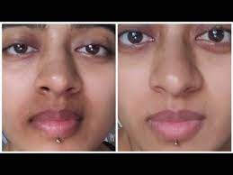 pigmentation treatment for mouth