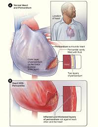 heart inflammation pericarditis