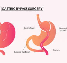gastric byp covered by insurance