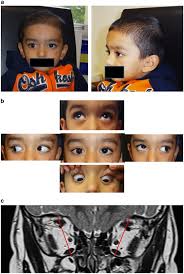 cranial nerve palsies in childhood eye