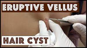 cysts eruptive vellus hair cysts