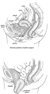 uterine prolapse and inal repair