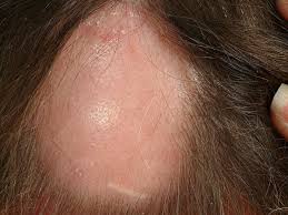 Clobetasol is available as a cream, ointment, lotion, foam and shampoo. Alopecia Areata Overview Altmeyers Encyclopedia Department Dermatology