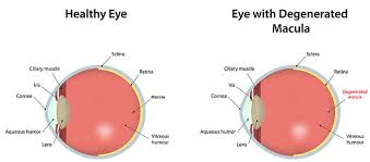 Macular Degeneration Sherman Eye Examination Gainesville Rgb