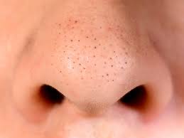 nose blackheads 15 best ways to remove