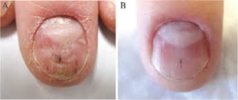 treatment of nail psoriasis with