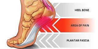 plantar fasciosis how to tell tips