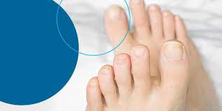 how to prevent and treat toenail fungus