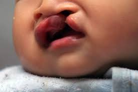 diffe types of cleft palates