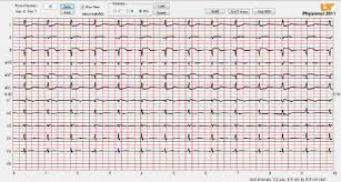 An Ecg In Which Channel V6 Is Partially Off The Chart