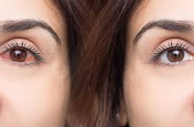 optometrists do for dry eye treatments