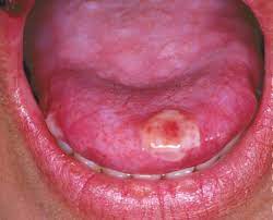 blisters on tongue blisters under or