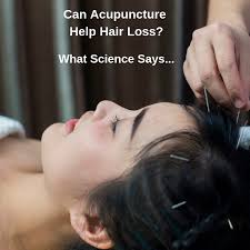 Mayo clinic says abrupt hair loss due to telogen effluvium could even happen a few months after the stressful event. Ees Can Acupuncture Help Hair Loss