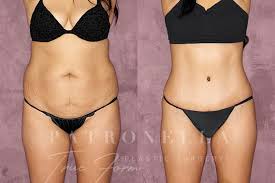 Having bbl and tummy tuck at the same time is asked by many of our patients. Tummy Tuck Abdominoplasty In Houston Tx Dr Christopher Patronella