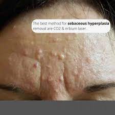 best sebaceous hyperplasia treatments