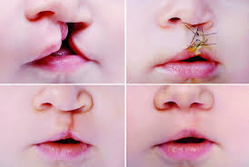 make cleft lip and palate repair a