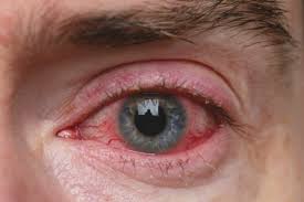eyelid inflammation in ocular rosacea