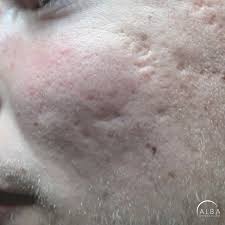 fractional co2 laser treatment for acne