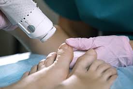 laser therapy treatment for toenail fungus