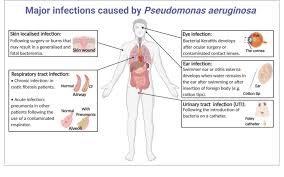 1 major infections caused by pa