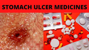 stomach ulcer pain relief