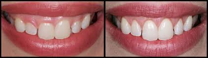 gummy smile gum contouring recovery