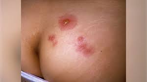 what does herpes look like pictures
