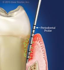 lanap procedure treating gum disease