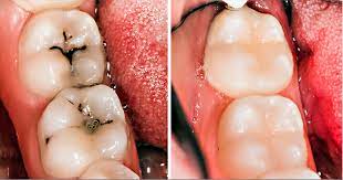 How to remove cavity from teeth at home? 8 Simple Ways To Naturally Reverse Cavities And Heal Tooth Decay