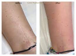 gold permanent makeup scars burns