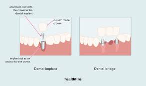 5 types of dental prosthesis devices