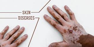 Image result for images of skin diseases