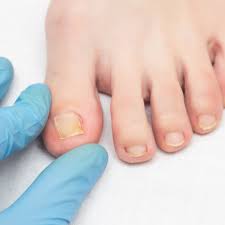 prevent ingrown toenails
