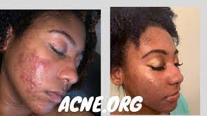 how i cleared my acne acne org pics